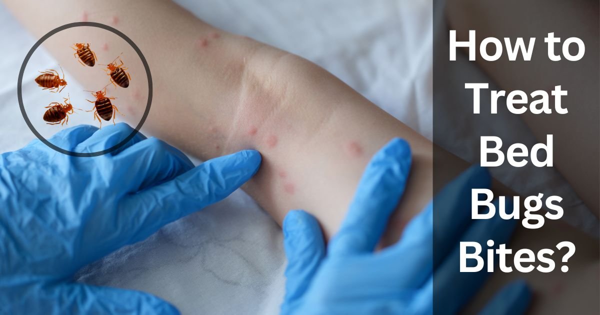 How To Treat Bed Bugs Bites How To Treat Bed Bugs Bites