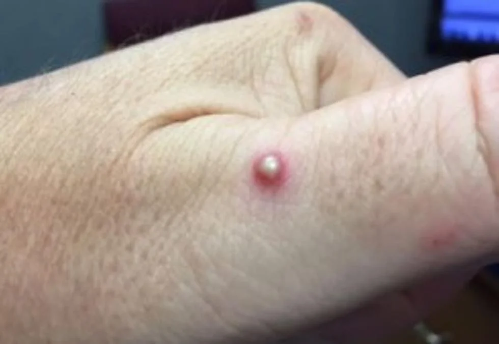 Are U Supposed to Pop Ant Bites