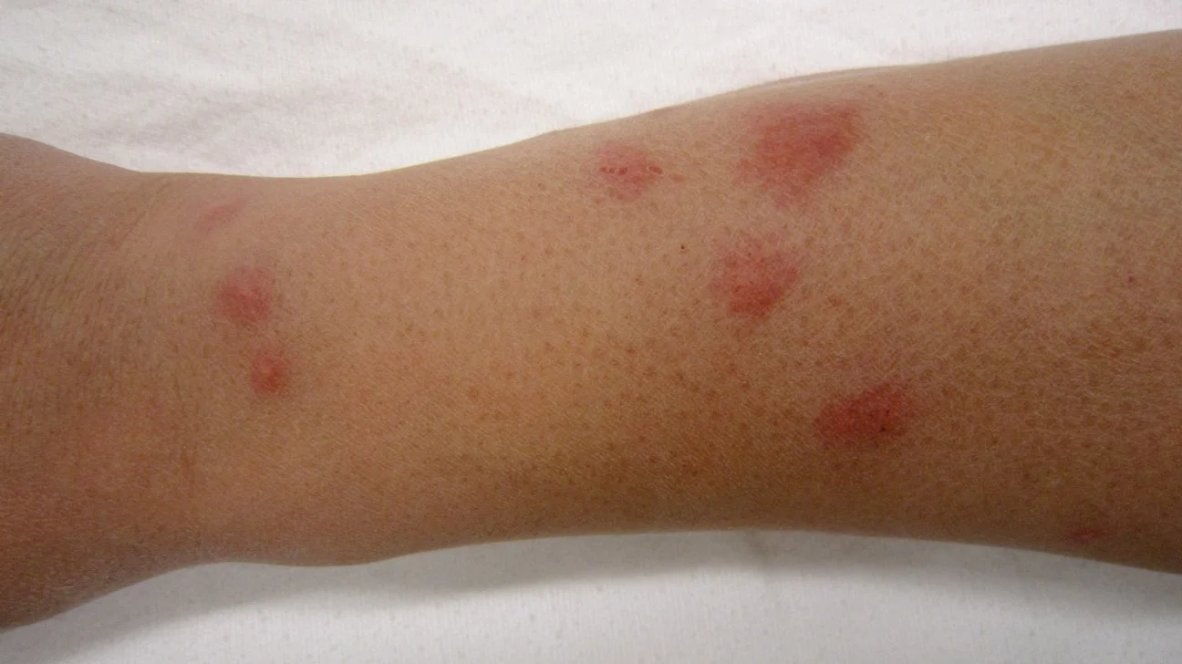 How Long Does It Take for Bed Bugs Bites to Show Up?