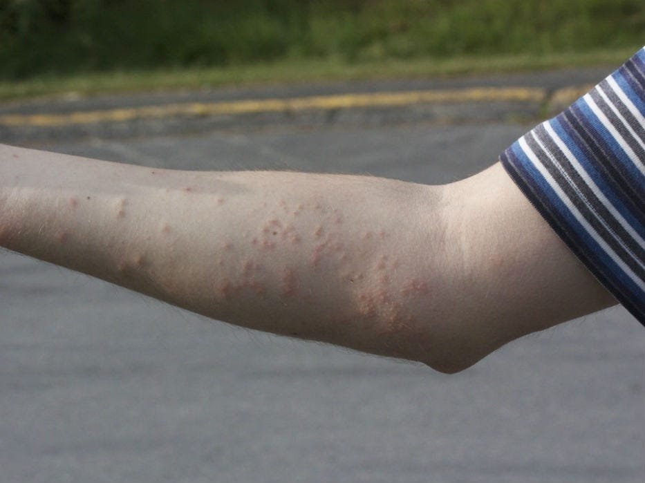 how to know if you are bitten by bed bugs How to Know If You are Bitten by Bed Bugs?