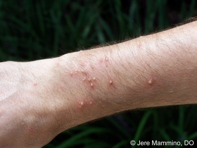 What If a Fire Ant Bites You