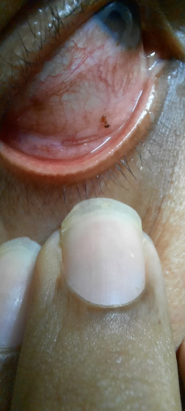 What to Do If Ant Bites Inside Eye