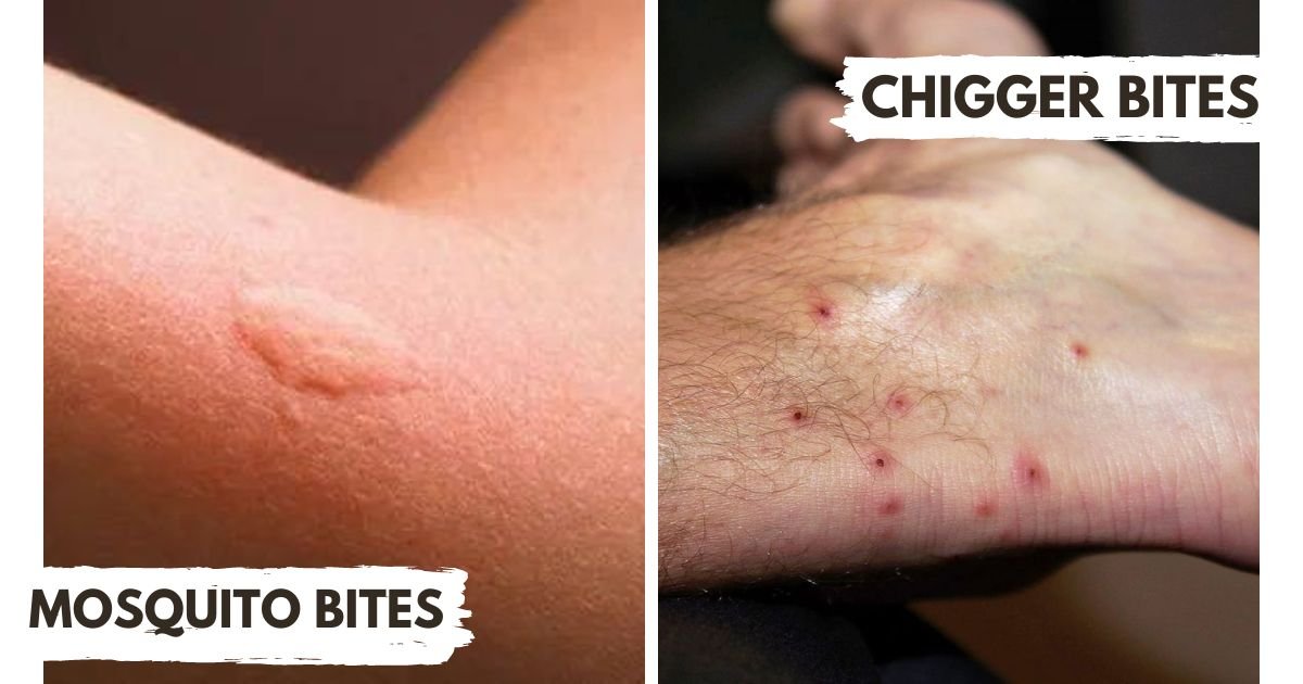 Difference between Mosquito Bites And Chigger Bites