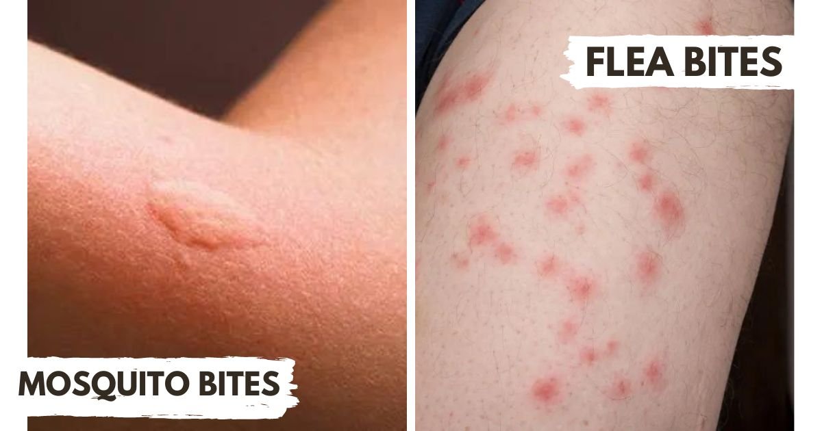 Mosquito vs Flea Bites