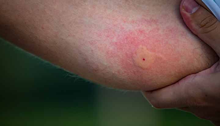 How Do Mosquitoes Know Where to Bite?