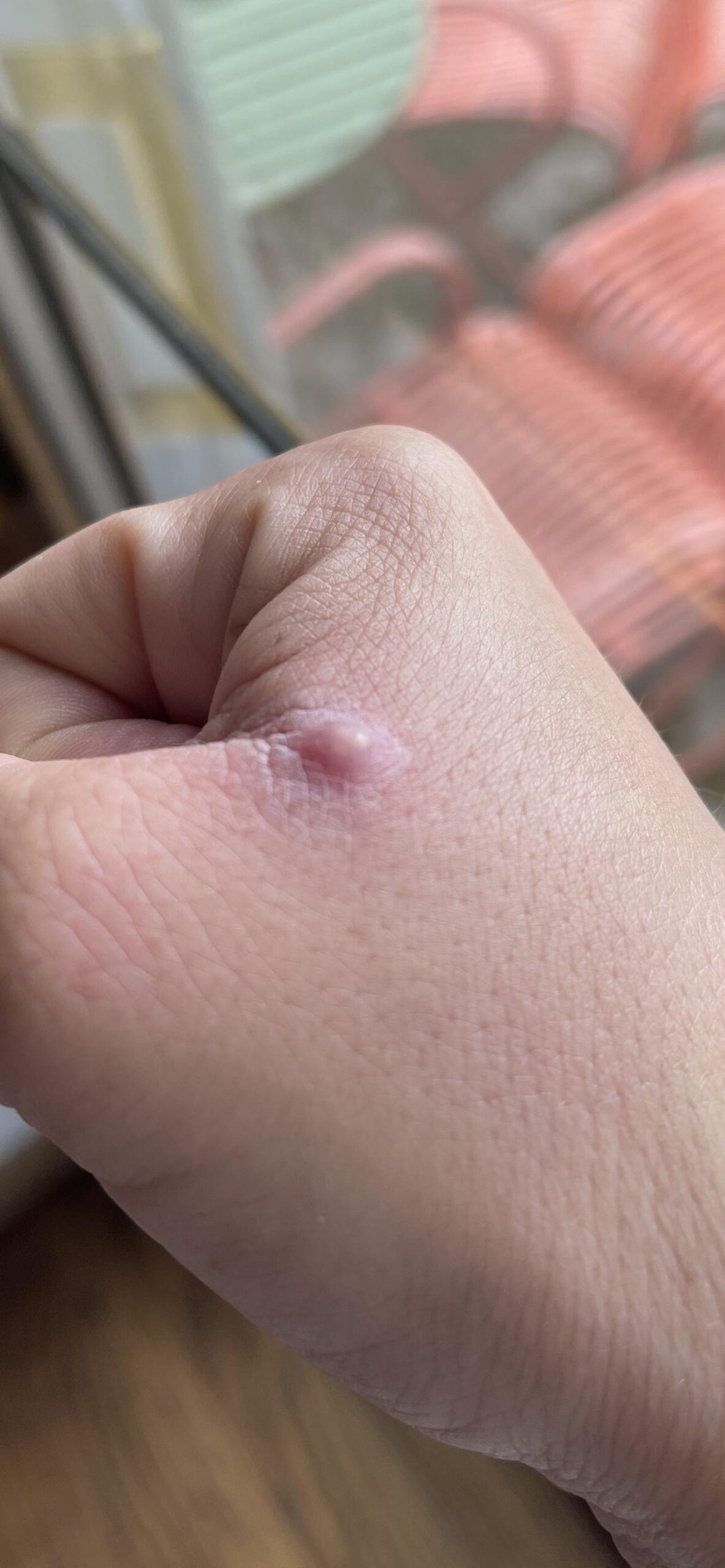 What If a Mosquito Bites Your Pimple?