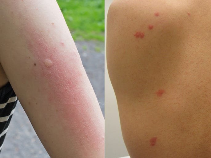 What is the Difference between Mosquito Bites And Bed Bug Bites?