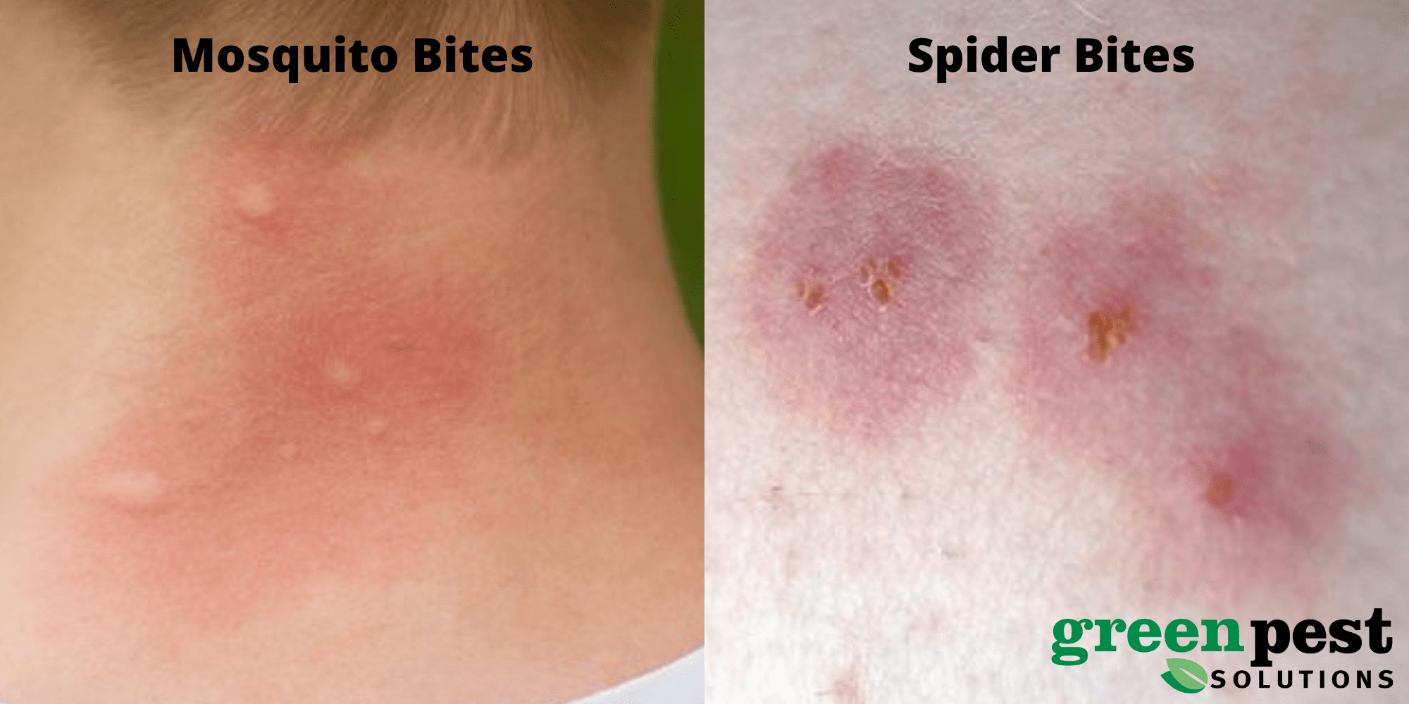 What is the Difference between Mosquito Bites And Spider Bites?
