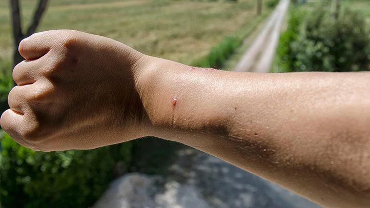 How Do You Know If Spider Bite is Poisonous?