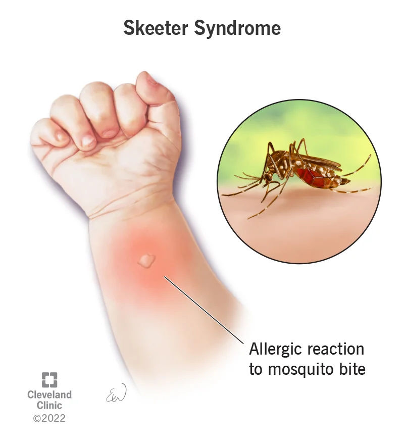What If a Mosquito Bite Gets Bigger?