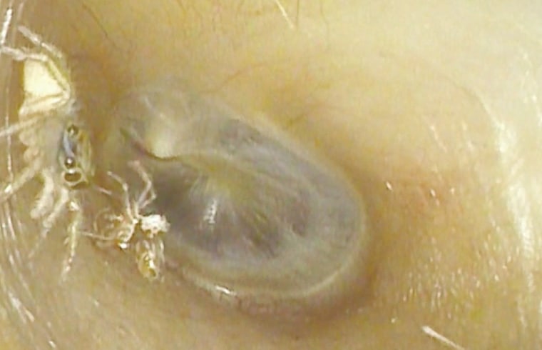 What to Do If Spider Goes in Ear?